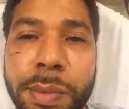 jussie-smollett-in-hospital-1
