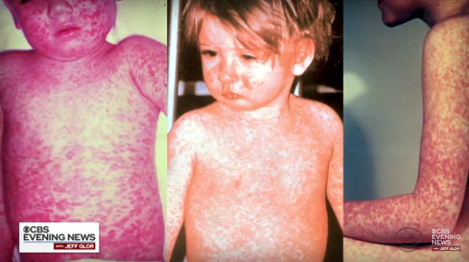 Measles Public Health