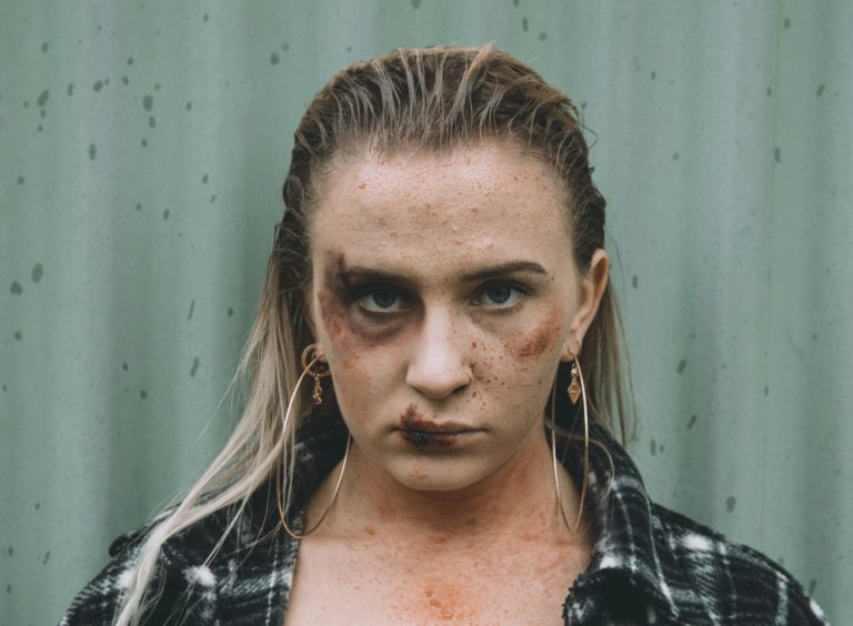 Abuse, woman bruised beaten