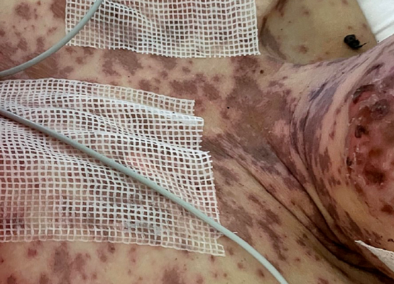 49- year old woman with Toxic Epidermal Necrolysis