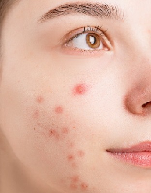 Acne pexels-anna-nekrashevich-6475987