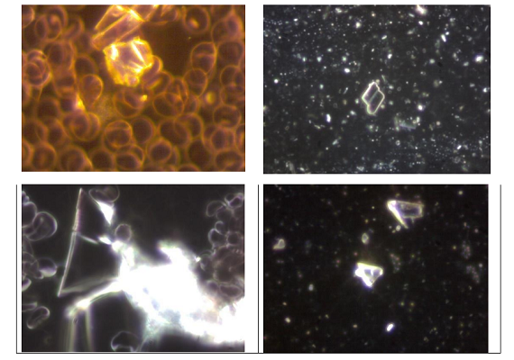 Crystals found in blood of vaccinated and in the vaccines